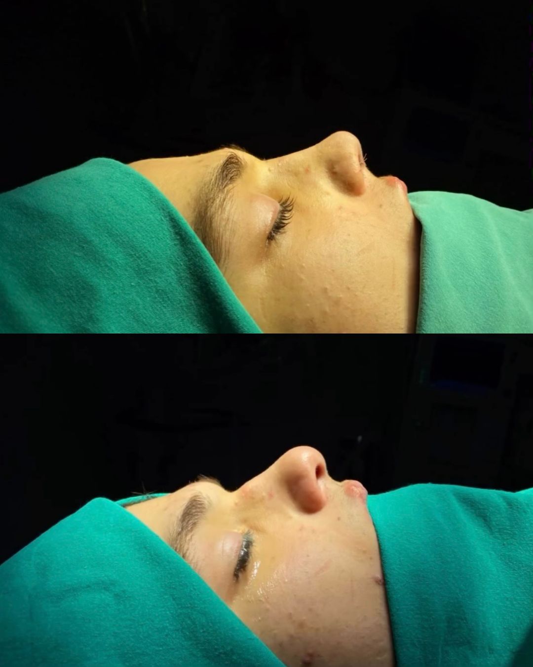 Rhinoplasty before after