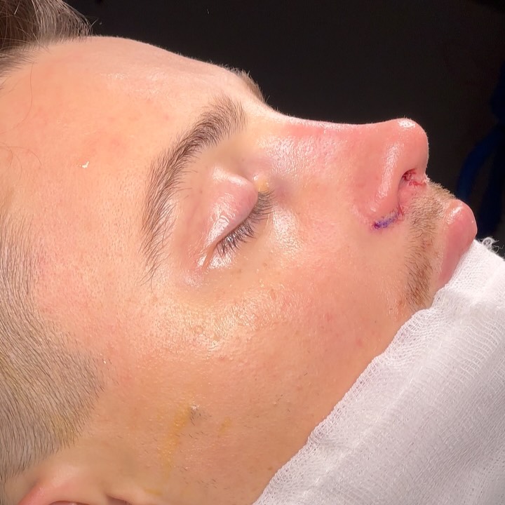After rhinoplasty