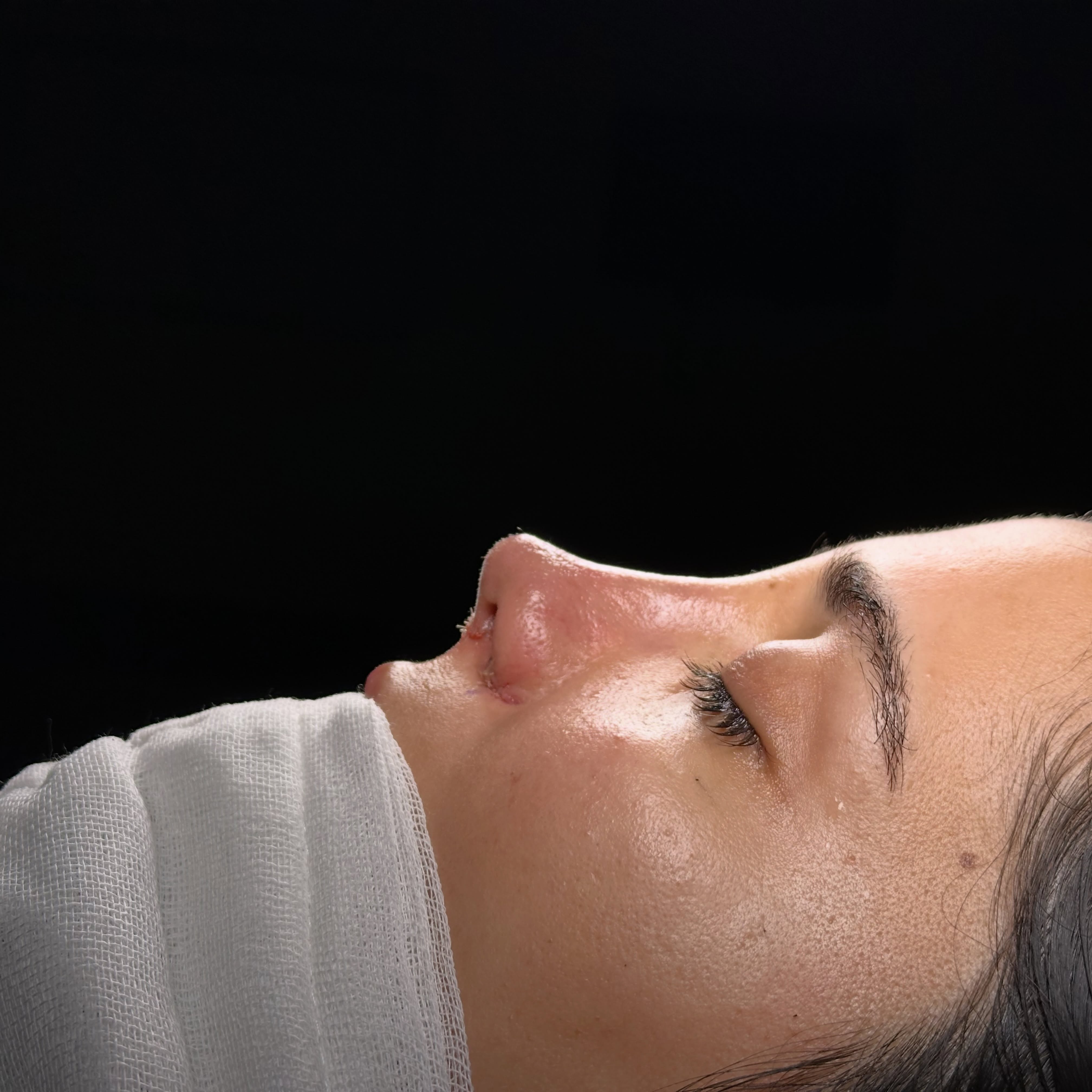 After rhinoplasty