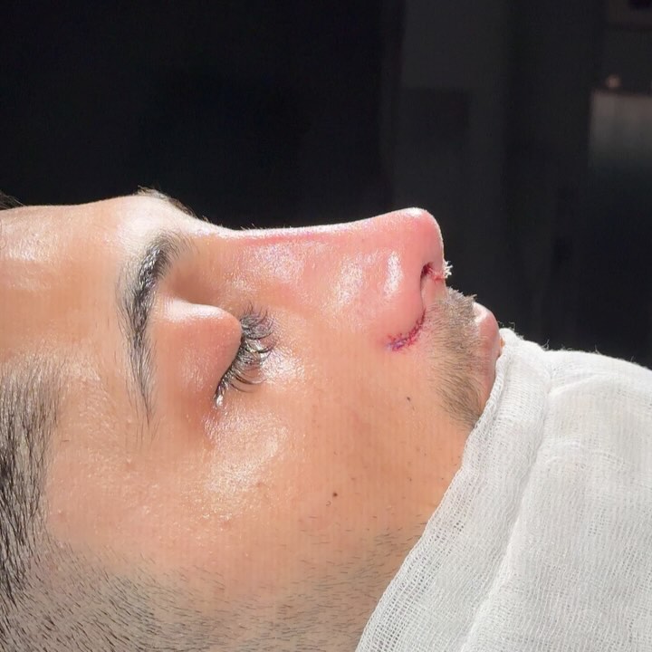 After rhinoplasty
