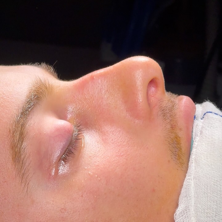 Before rhinoplasty