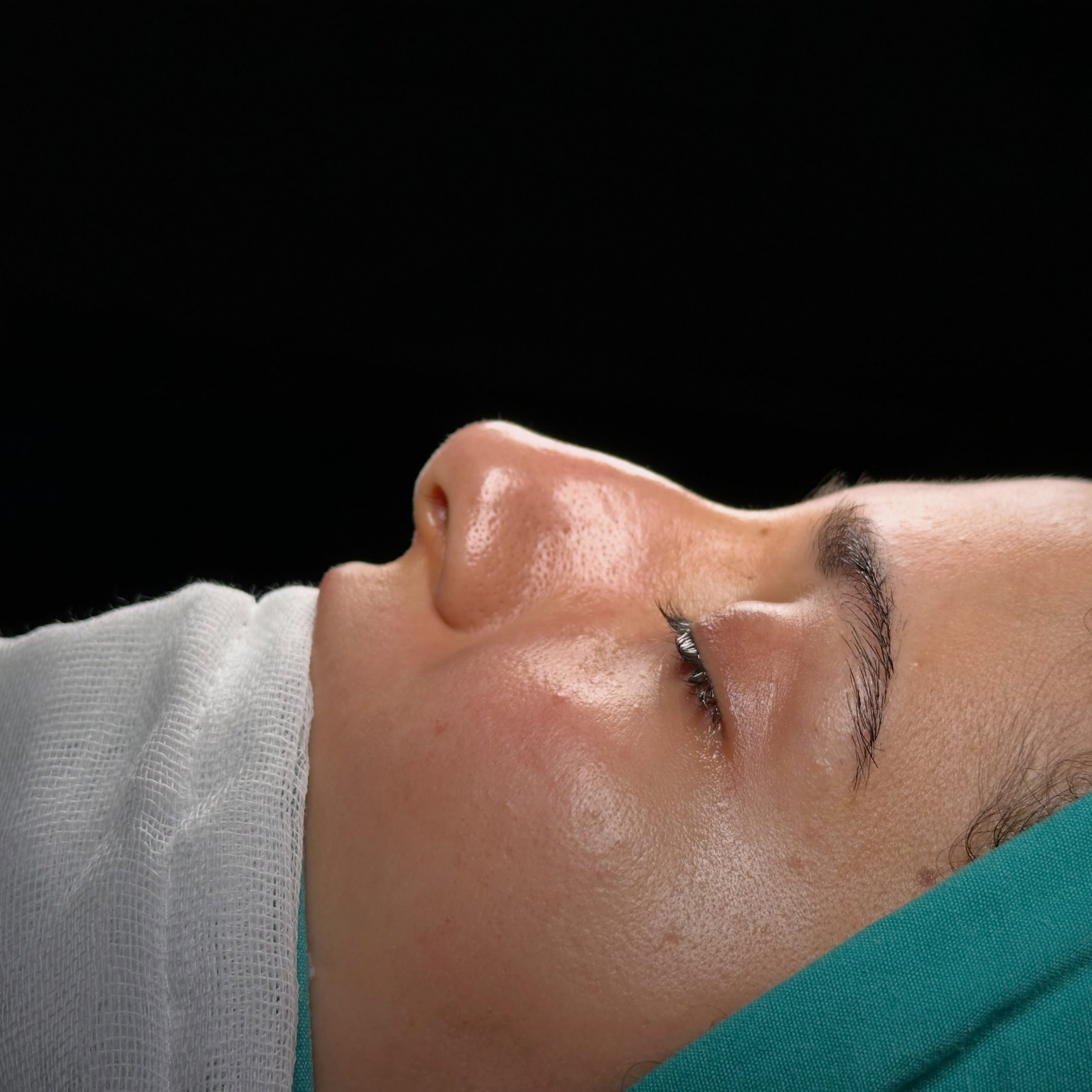 Before rhinoplasty