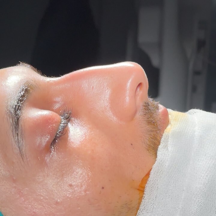 Before rhinoplasty
